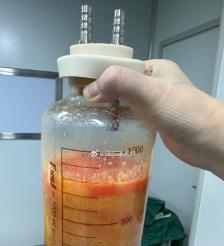 果洛水动力吸脂手术要做多久？